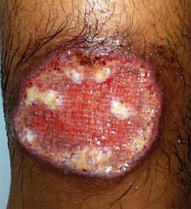 Localized Cutaneous Leishmaniasis 2