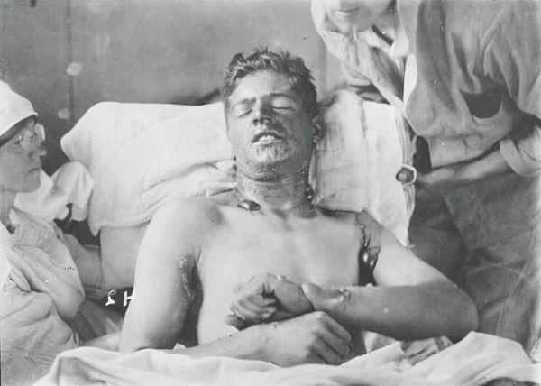 Mustard Gas testing