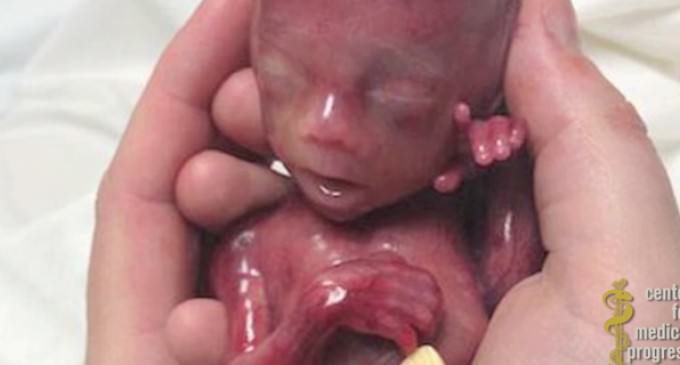 Planned Parenthood Havests Brain of Fetus With Beating Heart and Moving Limbs