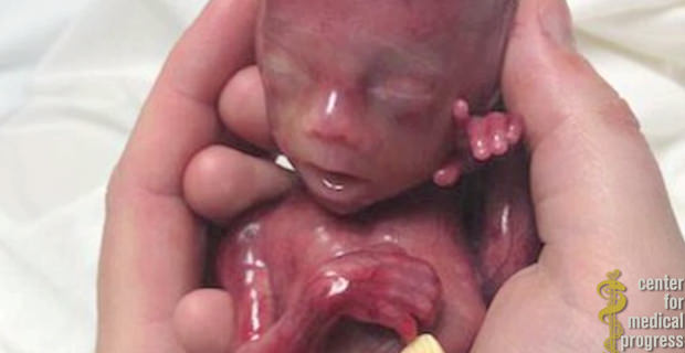Planned Parenthood Havests Brain of Fetus With Beating Heart and Moving Limbs