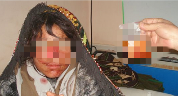 Afghan Woman Suffers Savage Nose Amputation by Husband, Who Flees To Taliban