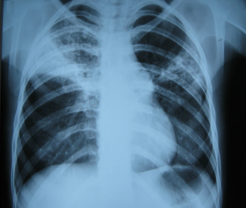 Idaho Becomes Seventh State with Confirmed TB Brought in by Migrants